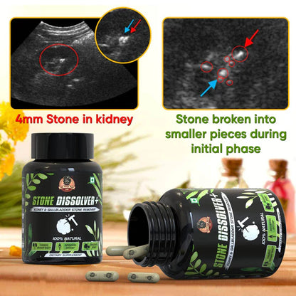 STONE DISSOLVER 🪨🔨 | Suplemento Renal para Cálculos e Infección